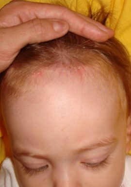 Baby without Congenital Birthmark on head New York NY