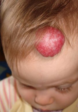 Baby with Congenital Birthmark on head New York NY