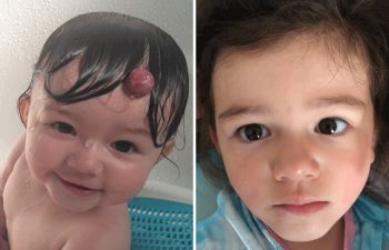 Baby with and without Congenital Birthmark New York NY, 