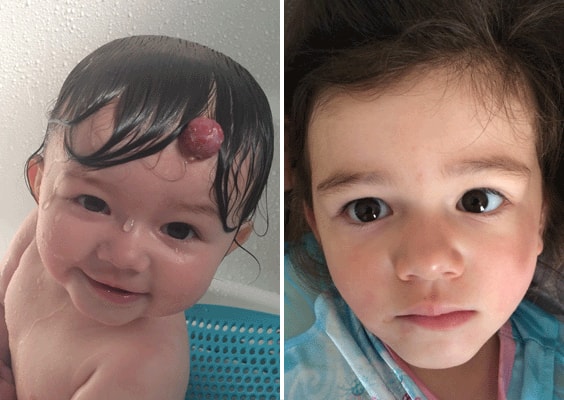 Baby with and without Congenital Birthmark New York NY