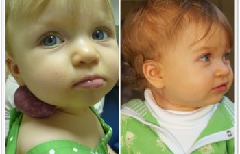 (a) 12 month old with right neck compound hemangioma; (b) 1 month postoperative result