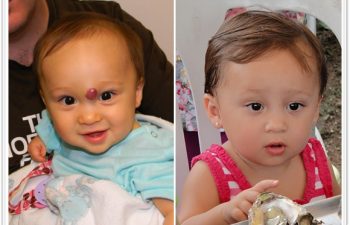 a) 9 month old with mid-forehead compound hemangioma (non responsive to propranolol therapy); b) 3 month follow up with well healed scar avoiding eyebrow displacement