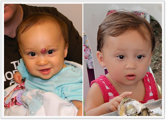 🥇 New York Hemangiomas Before and After Photos