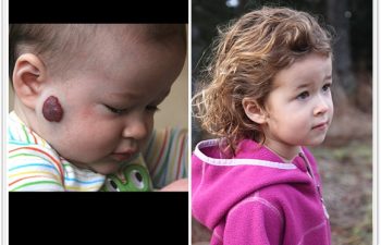 (a) Patient with right cheek hemangioma, unresponsive to oral propranolol (b) 20 months status post surgery and laser therapy