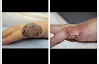 (a) Left hand lymphatic malformation; (b) 6 week postop result after skin graft repair