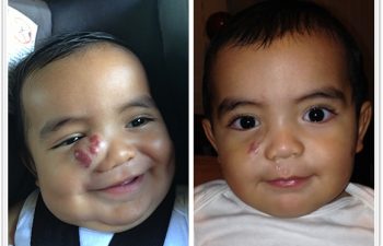 (a) 10 month old with right nasal/cheek hemangioma, unresponsive to propranolol therapy; (b) 3 month postop result before additional laser therapy