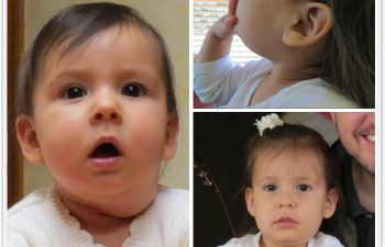 (a) 10 month old with lymphatic malformation of the left neck and parotid; (b) 6 month postoperative result with well healed neck scar; (c) Postop with normal facial nerve function