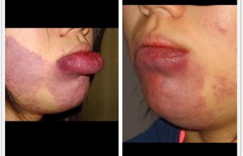 (a) 14 year old with port wine stain of the lip; (b) 3 month postop result with scar hidden within the inner lining of the lip