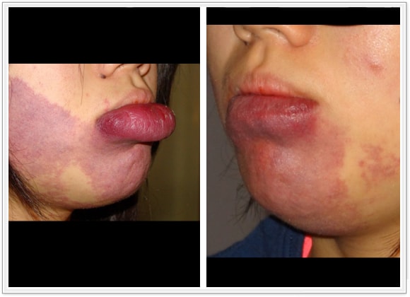 (a) 14 year old with port wine stain of the lip; (b) 3 month postop result with scar hidden within the inner lining of the lip