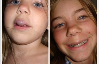 a) 12 yo with venous malformation of the midlip with inability to close lips tightly; b) 1-year follow up with symmetric lip and contour.