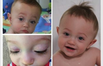 (a) 9 month old with a right eyelid compound hemangioma with astigmatism, unresponsive to propranolol; (b) 6 week postoperative result, normal vision