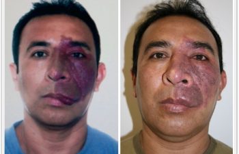 (a) 35-year-old with left hemifacial port wine stain hypertrophy of the lip and cheek; (b) 1 year follow up after surgical reconstruction with postoperative laser therapy with restored contour and symmetry of the lip and cheek