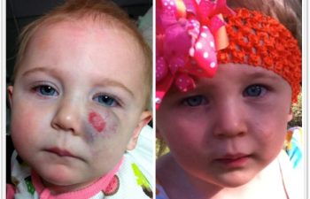 (a) 10 month old with left cheek compound hemangioma, not responsive to propranolol; (b) 3 month postoperative result; (c) 1 year postoperative result