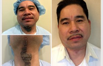 (a) Preop Sebacous Nevus of the neck, (b)Vertical extension to chin, (c)3 month postoperative result from one surgery