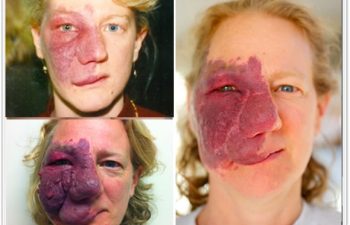 (a) Right hemifacial port wine stain with early hypertrophic changes as a young woman; (b)Extensive hemifacial hypertrophy after 25 years left untreated; (c)Postoperative result after 3 reconstructive procedures, 