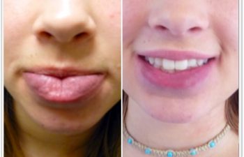(a)14 yo female with port wine stain hpertrophy of the lower lip; (b)3 month postoperative result