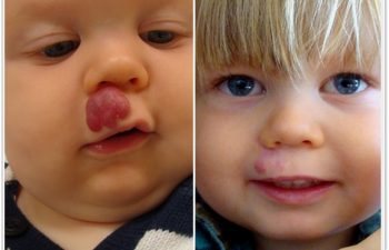 (a) Preop of compound hemangioma of upper lip that was unresponsive to medical and laser therapy; (b) 6 month postoperative result