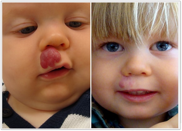 🥇 New York Hemangiomas Before and After Photos