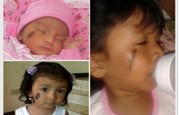 (a)Congenital hairy nevus of right cheek at birth; (b)Further darkening and stretching after 18months, no treatment; (c)Current result after 3 stage serial excision (no tissue expander), awaiting final excision