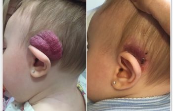 (a) Preop hemangioma of ear; no response to oral propranolol; (b) Two week postoperative result, awaiting additional laser therapy to residual skin.