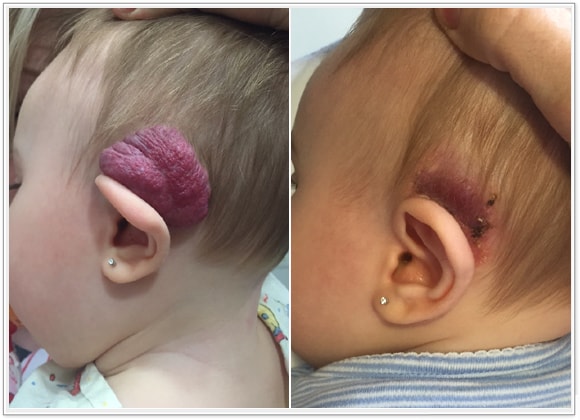 (a) Preop hemangioma of ear; no response to oral propranolol; (b) Two week postoperative result, awaiting additional laser therapy to residual skin.