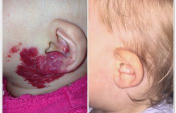 (a) pretreatment photo of 2 month old with a proliferating hemangioma; (b) After 6 months of oral Hemangeol therapy and 2 laser treatments
