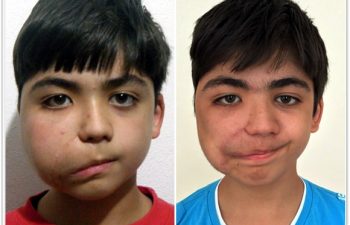 (a) 11 year old preop: previous incomplete surgery causing facial nerve paralysis; (b) 4 month postop result from surgical debulking and reconstruction (Dr. Levitin) and facial nerve reanimation (Dr. Mashkevich)