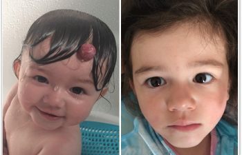 (a) Preop photo of mid-forehead hemangioma; (b) One year follow up with well healed incision, barely noticeable