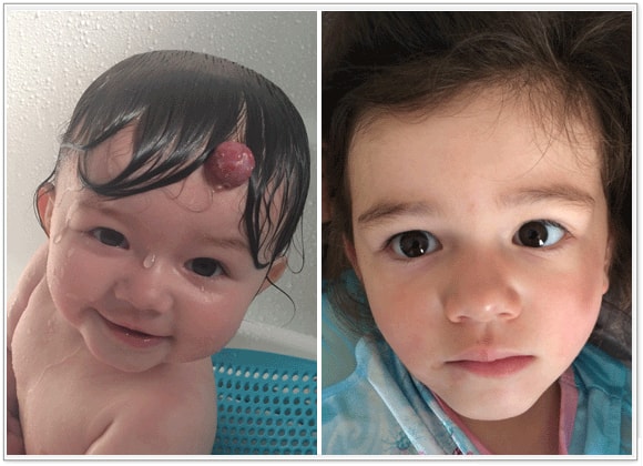 🥇 New York Hemangiomas Before and After Photos