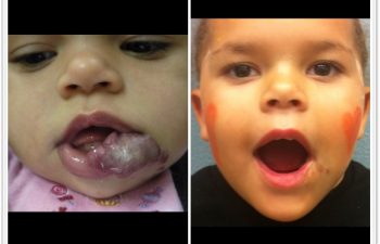 (a) 10 month old with ulcerated hemangioma of the lip and chin; (b) 18 month follow up after 2-stage operation