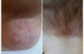 (a) Preop photo of a 9 month old girl with a large, noninvoluted hemangioma of the posterior neck causing restriction of head movement; (b)6 month postoperative result from just one surgery with a well healed incision hidden within the hairline