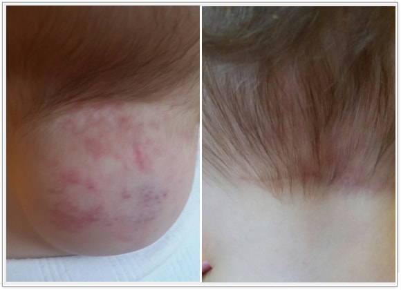 🥇 New York Hemangiomas Before and After Photos