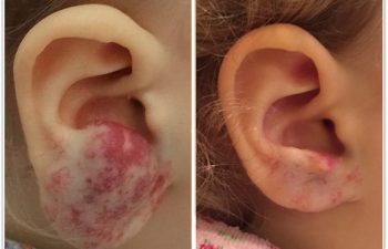 (a) Preop photo of right ear hemangioma, unresponsive to oral propranolol therapy; (b) 10 months postop result from surgical debulking with normal appearance restored