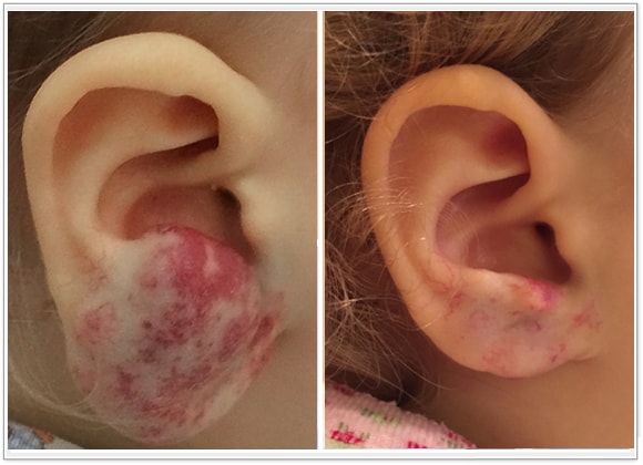 🥇 New York Hemangiomas Before and After Photos