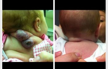 (a) 6 month old with compound hemangioma with ulceration; (b) 1 month postoperative result