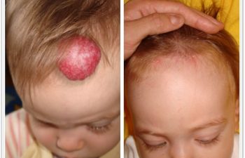 (a) 12 month old with forehead/scalp compound hemangioma; (b) 1 month postop with scar well concealed within hair line