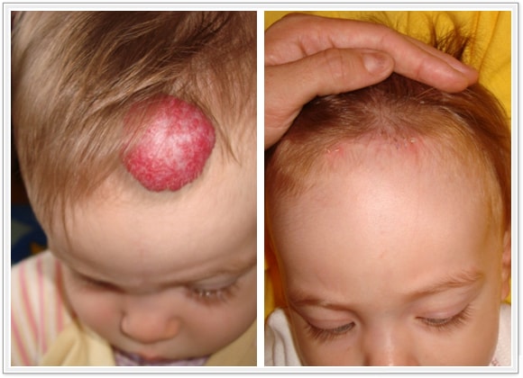 🥇 New York Hemangiomas Before and After Photos