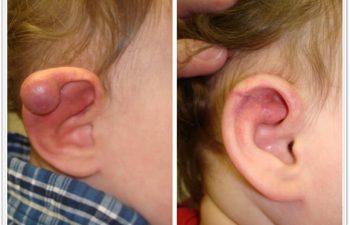 (a) 3 year old with right ear arteriovenous malformation; (b) 2 month postoperative result