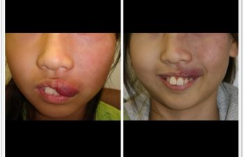 (a) 13 year old with left upper lip port wine stain hypertrophy; (b) 3 month postoperative result