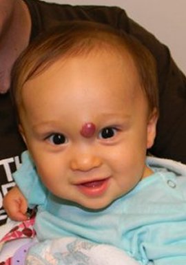 Baby with Congenital Birthmark New York NY