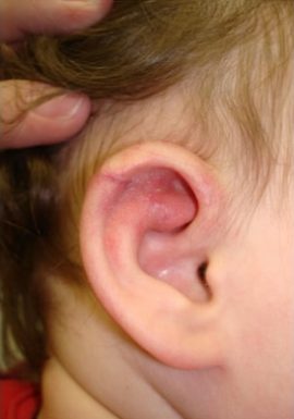 Baby without Congenital Birthmark on ear New York NY