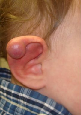 Baby with Congenital Birthmark on ear New York NY