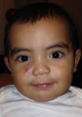 Baby with Congenital Birthmark on cheek New York NY