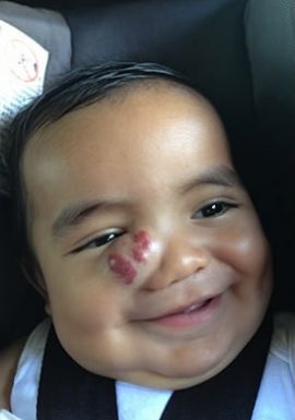 Baby with Congenital Birthmark on cheek New York NY