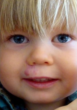 Baby without Congenital Birthmark on lip New York NY