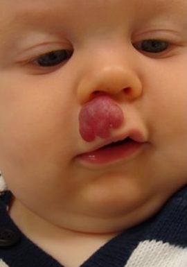 Baby with Congenital Birthmark on lip New York NY