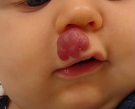 Baby with Congenital Birthmark on lip New York NY