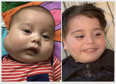 🥇 New York Hemangiomas Before and After Photos