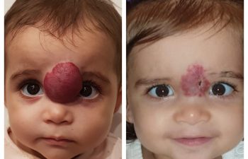 Little Noor came all the way from Kuwait to get her hemangioma surgery just in time for her first birthday!