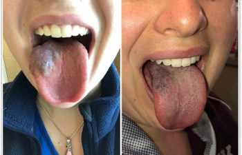 (a) This young woman with a venous malformation of her tongue had gradual swelling, pain, and difficulty with speech and swallowing; she came to the Vascular Birthmark Center to see what treatment options were available (b) After three laser treatments and one surgery, her tongue is now back to normal size, shape and contour; she can eat and speak without any problems! (the color does not bother her).